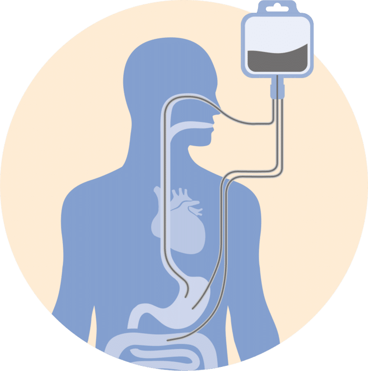 Enteral Tube Feeding - Medical Nutrition Industry